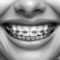 Consejos para pacientes con brackets: alimentación y limpieza, Clinica Dental