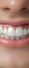 Dientes sensibles: soluciones que realmente funcionan, Clinica Dental